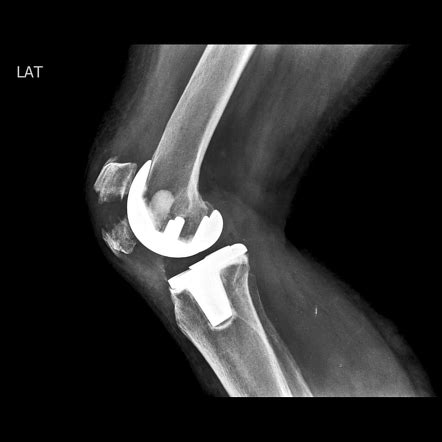 Patellar fracture | Radiology Case | Radiopaedia.org