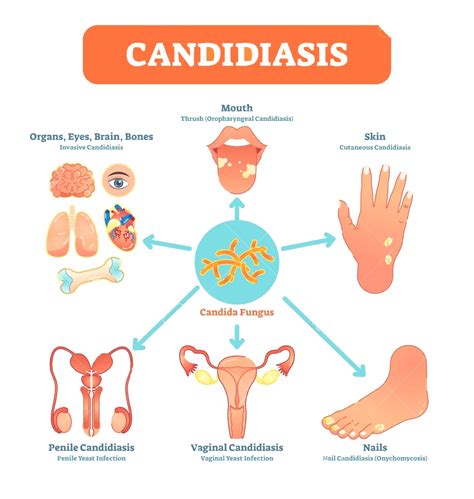 Core Naturopathics | Candida Treatment Success with Ozone Therapy