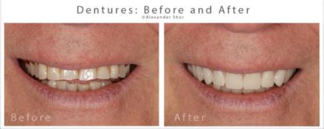 Dentures Before & After Seattle - Shor Dental