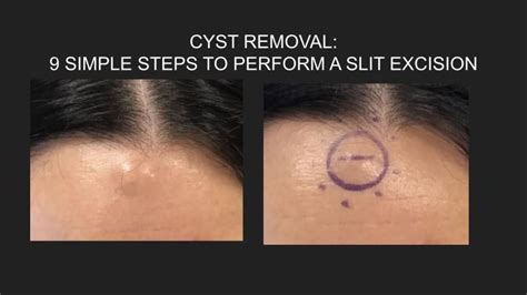 Video: Steps for Cyst Removal