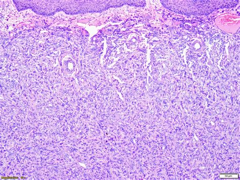 Dermatofibroma Histology