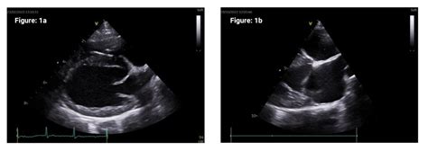 Staging of Preclinical Myxomatous Mitral Valve Disease in Primary ...