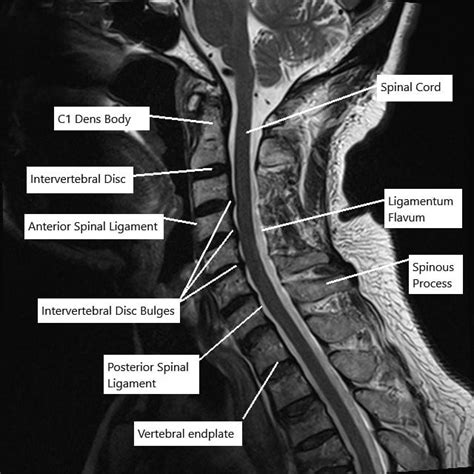 Mri Cervical Spine Lumbar Spine Mri Scan Images Spinal Stenosis ...