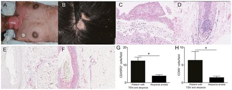 Scarring Alopecia Histology