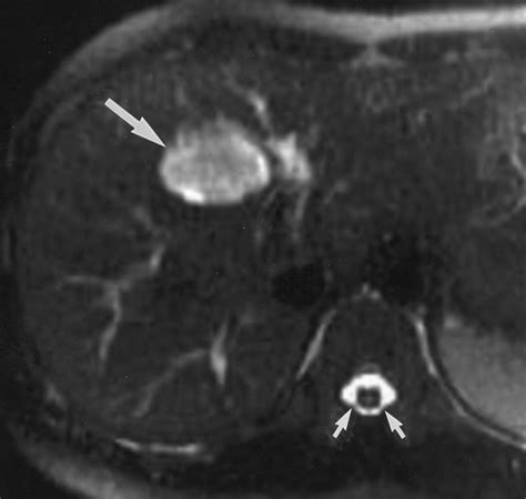 Hepatic Hemangioma Ultrasound