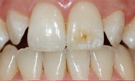 Brown Spots On Teeth | Renew Physical Therapy