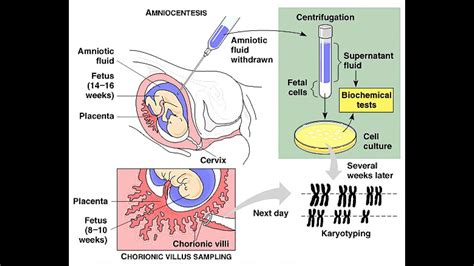 Amniocentesis vs Chorionic Villus Sampling - YouTube