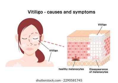 Causes Symptoms Vitiligo Vector Illustration Stock Vector (Royalty Free ...