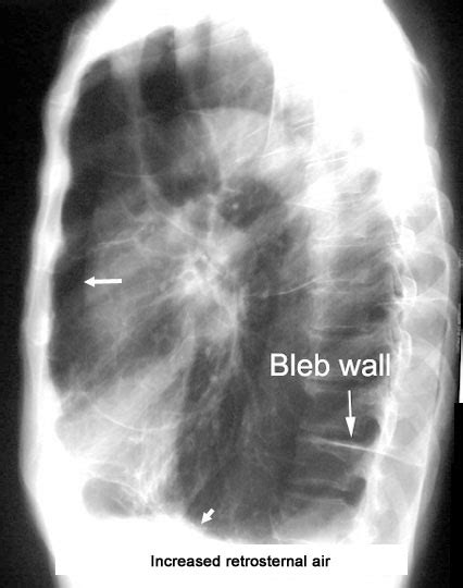 Medical Addicts: X-ray findings of emphysema