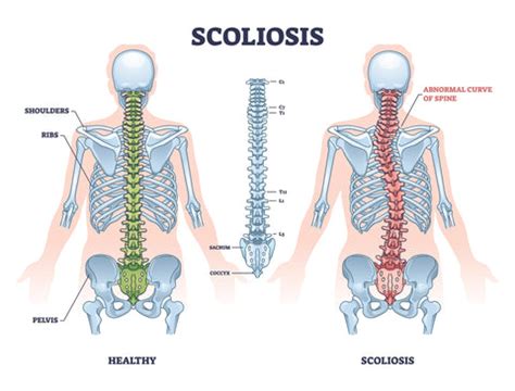 Mild Scoliosis: Is It Serious or Normal? Top Signs to Look For - Easy ...