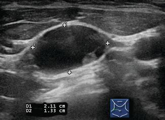 Ultrasound Of Lymph Nodes In Neck