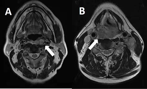 Figure 1 from Retropharyngeal Lymph Node Metastasis Diagnosed by ...