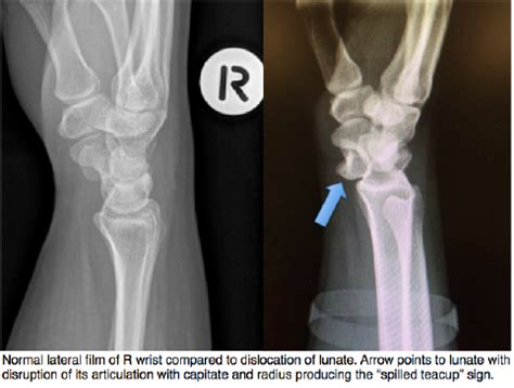 Lunate Dislocation – Core EM