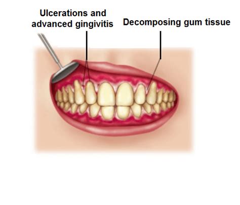 Necrotizing Ulcerative Gingivitis