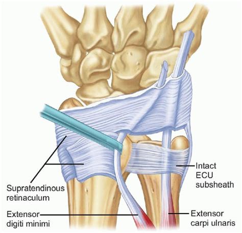 Surgical Treatment for Extensor Carpi Ulnaris Subluxation ...