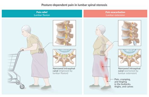 Lumbar Spinal Stenosis Cauda Equina Syndrome Sciatica