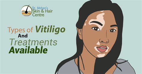 Types of Vitiligo And Treatments Available