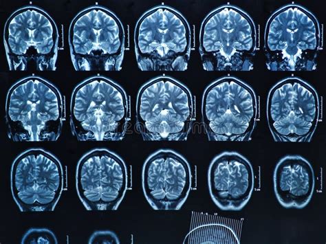 MRI Brain Scan stock image. Image of imagery, diagnosis - 28673367