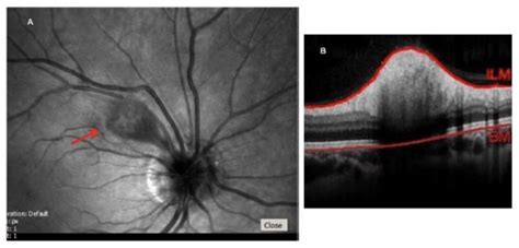 Right eye cotton-wool spot appearance on infrared imaging (A, arrow ...