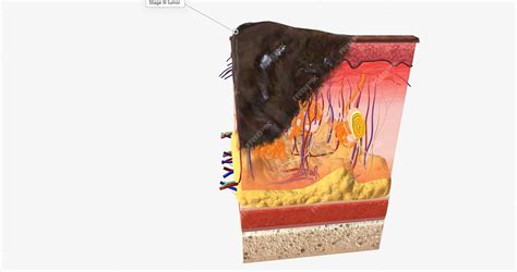 Premium Photo | The in stage iii alm acral lentiginous melanoma