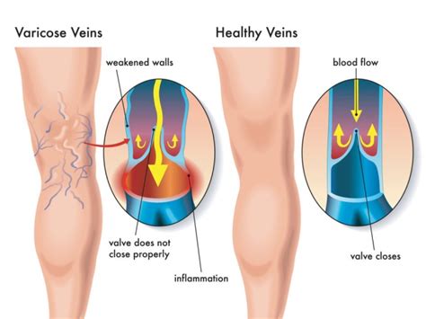 How To Help Varicose Veins - Causes, Treatment & All You Need To Know.