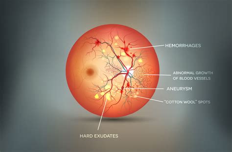 Cotton Wool Spots: Causes and Symptoms