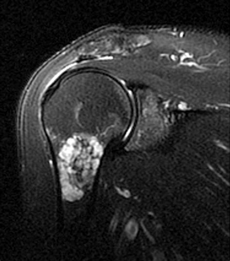 Chondroma In Knee X Ray