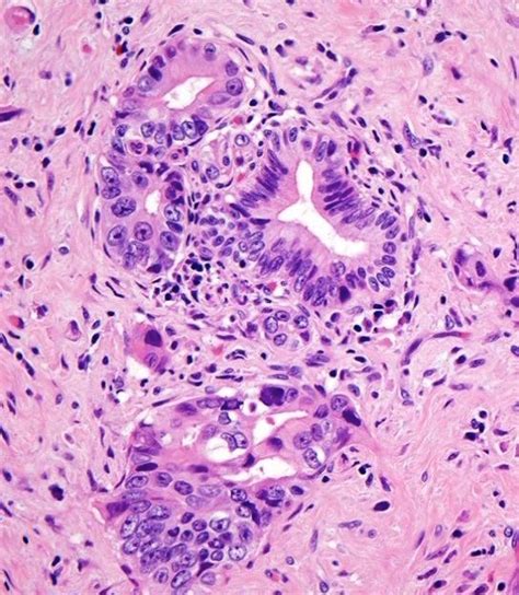 Pancreatic Ductal Adenocarcinoma PDAC