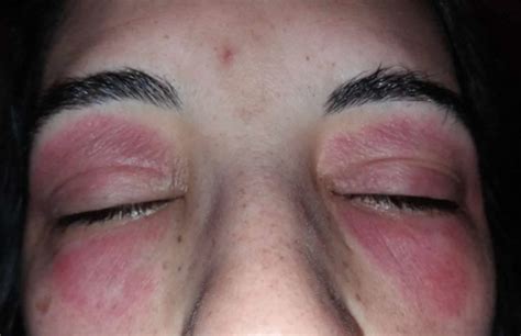 Eyelid dermatitis causes, symptoms, diagnosis & treatment