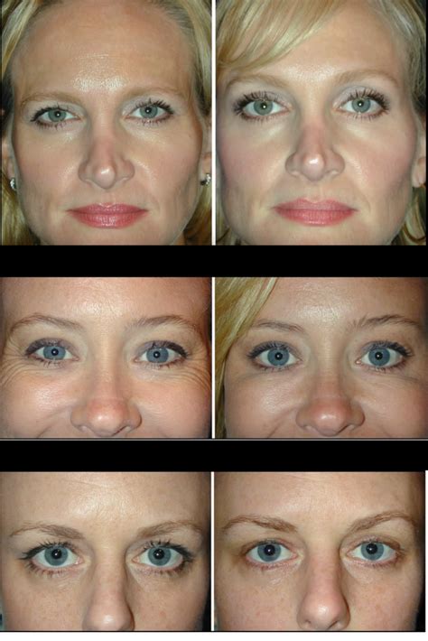 Botox Between Eyebrows Before And After - EyebrowShaper