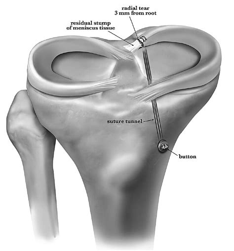 Torn Meniscus Surgery Cost With Insurance - Life Insurance Quotes