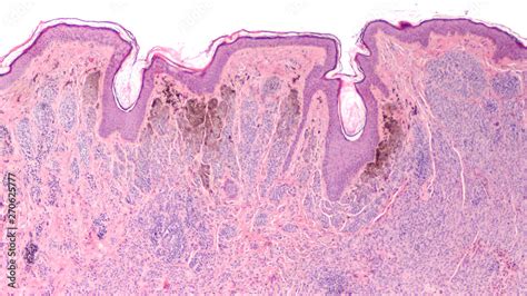 Photomicrograph of a skin biopsy showing histology of an intradermal ...