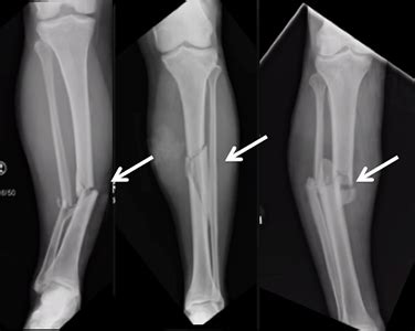 Tibia And Fibula Fracture