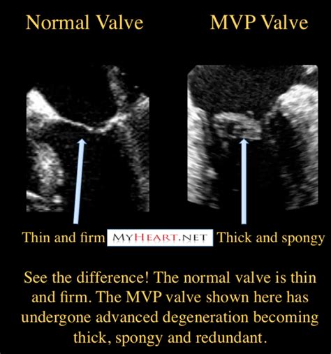 Myxomatous Mitral Valve Disease - Captions Beautiful