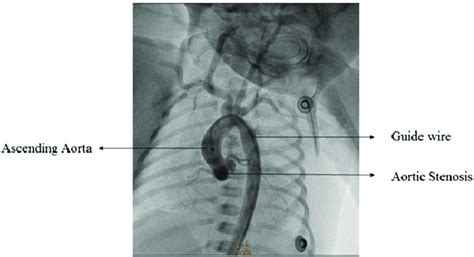 Aortic stenosis on angiography. | Download Scientific Diagram