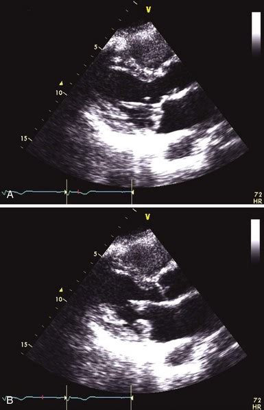 Myxomatous Mitral Valve Disease | Thoracic Key