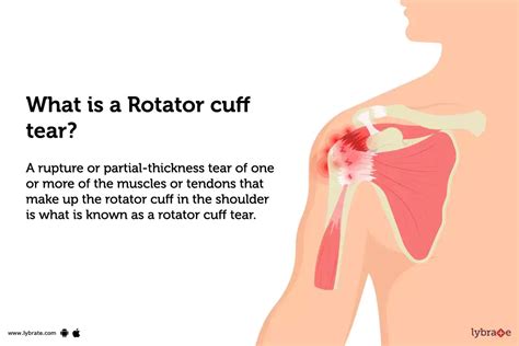 rotator cuff injury - mi-pro.co.uk