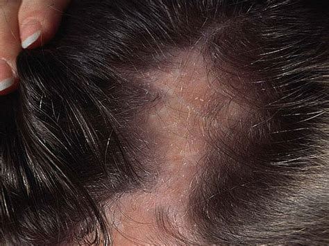 What is Scarring Alopecia | Causes, Symptoms & Treatments