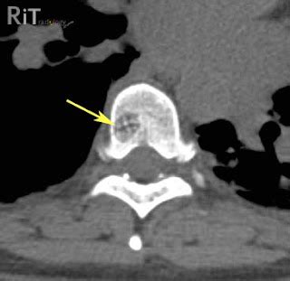 RiT radiology: Spinal Hemangioma