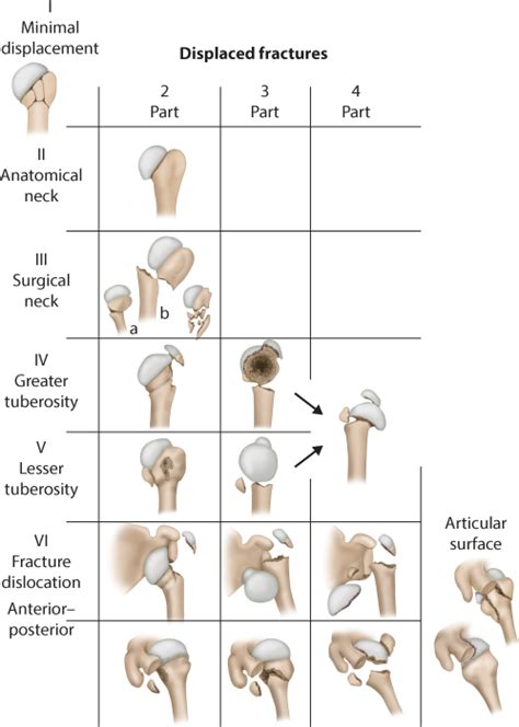 Proximal Humeral Fracture Classification