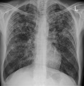 Tuberculosis radiology - Wikipedia