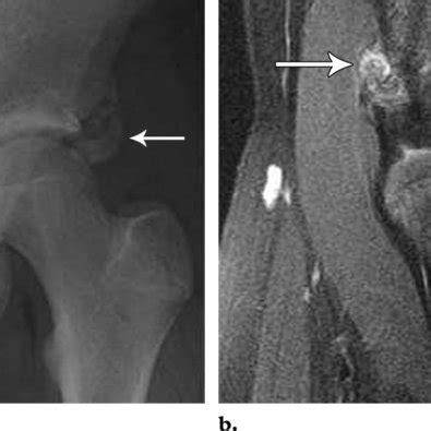 Patellar sleeve fracture in an 11-year-old boy who was injured when he ...