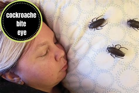 Cockroach Bite Eye Symptoms, Causes, Prevention And Treatment - The ...