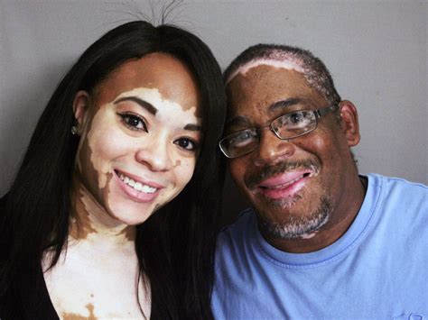 Vitiligo appreciation thread | Sports, Hip Hop & Piff - The Coli