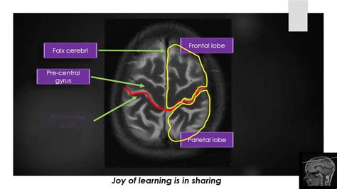 Brain Anatomy On Mri - Anatomical Charts & Posters