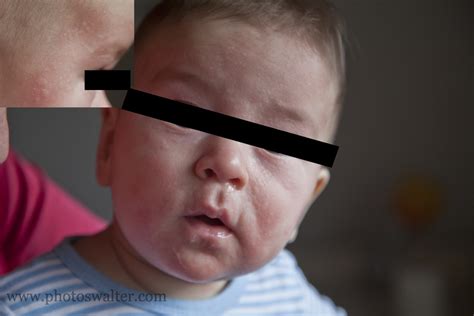 Allergy symptoms in babies | General center | SteadyHealth.com