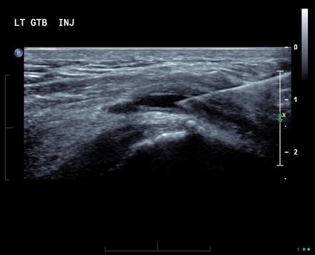 Trochanteric Bursitis Injection Technique