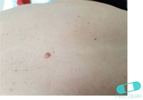 Intradermal nevus | First Derm