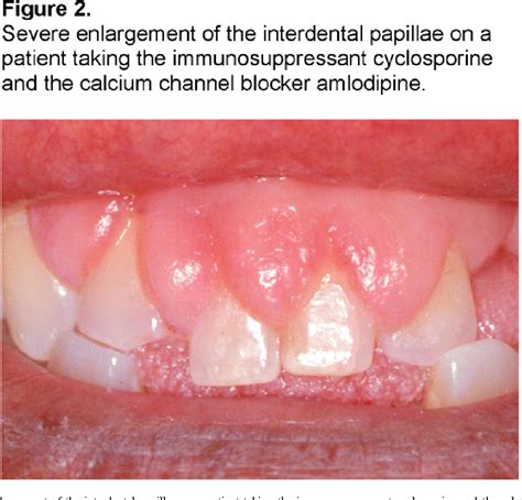 Drug Induced Gingival Hyperplasia Exodontia | The Best Porn Website