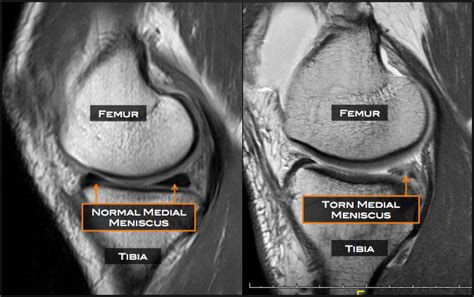 Torn Medial Meniscus Tear